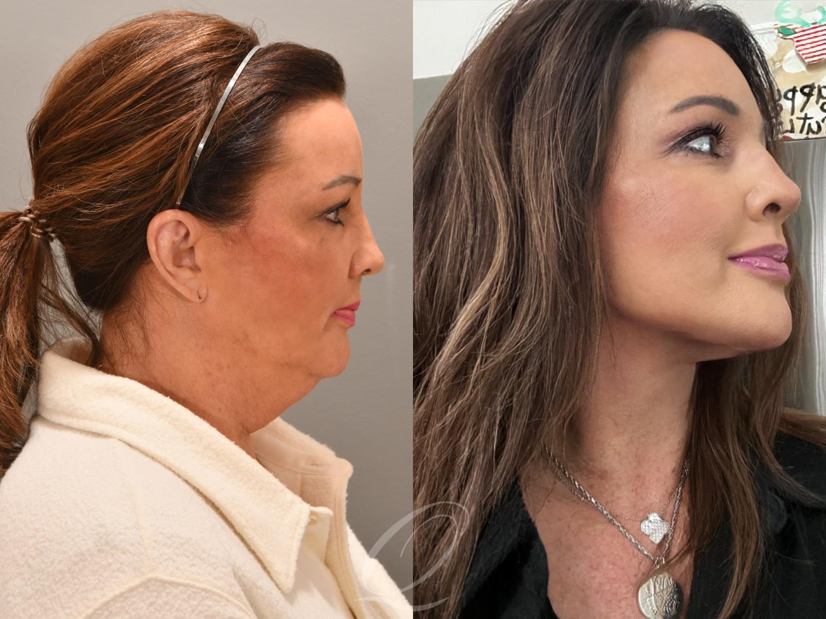 Facelift Case 1001860 Before & After Right Side | Serving Rochester, Syracuse & Buffalo, NY | Quatela Center for Plastic Surgery