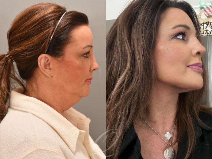 Facelift Case 1001860 Before & After Right Side | Serving Rochester, Syracuse & Buffalo, NY | Quatela Center for Plastic Surgery