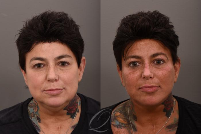 Facelift Case 1001863 Before & After Front | Serving Rochester, Syracuse & Buffalo, NY | Quatela Center for Plastic Surgery