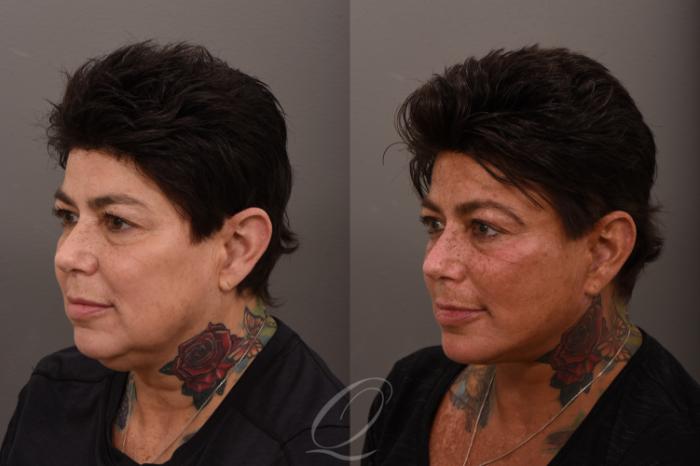 Facelift Case 1001863 Before & After Left Oblique | Serving Rochester, Syracuse & Buffalo, NY | Quatela Center for Plastic Surgery