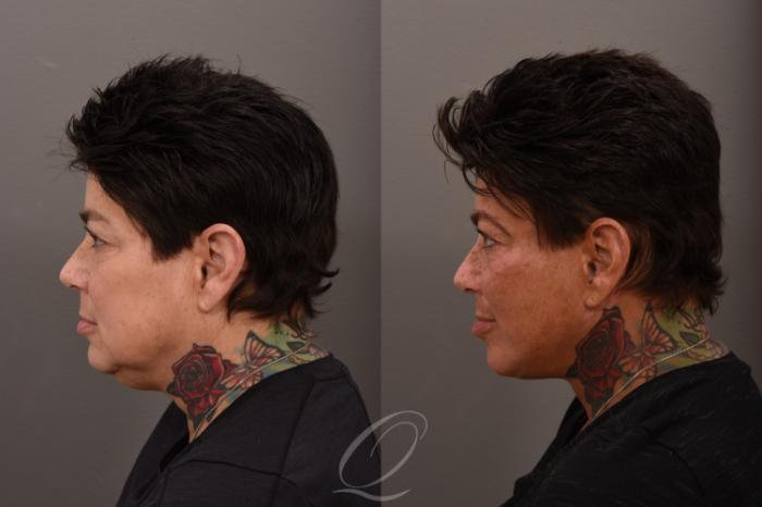 Facelift Case 1001863 Before & After Left Side | Serving Rochester, Syracuse & Buffalo, NY | Quatela Center for Plastic Surgery