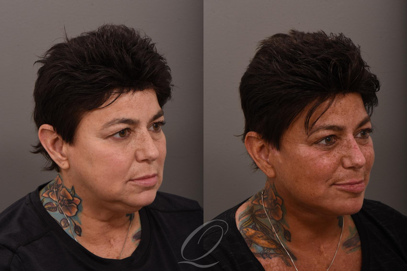 Facelift Case 1001863 Before & After Right Oblique | Serving Rochester, Syracuse & Buffalo, NY | Quatela Center for Plastic Surgery