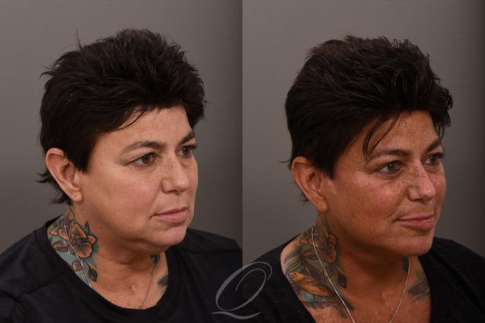 Facelift Case 1001863 Before & After Right Oblique | Serving Rochester, Syracuse & Buffalo, NY | Quatela Center for Plastic Surgery