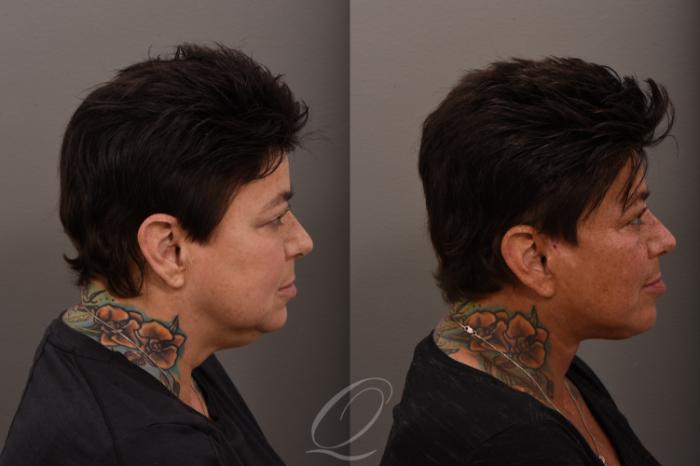 Facelift Case 1001863 Before & After Right Side | Serving Rochester, Syracuse & Buffalo, NY | Quatela Center for Plastic Surgery
