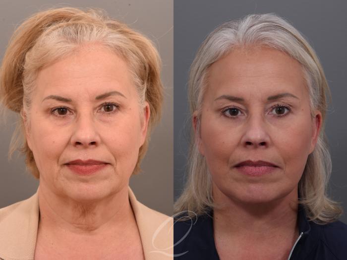 Brow Lift Case 1001897 Before & After Front  | Serving Rochester, Syracuse & Buffalo, NY | Quatela Center for Plastic Surgery