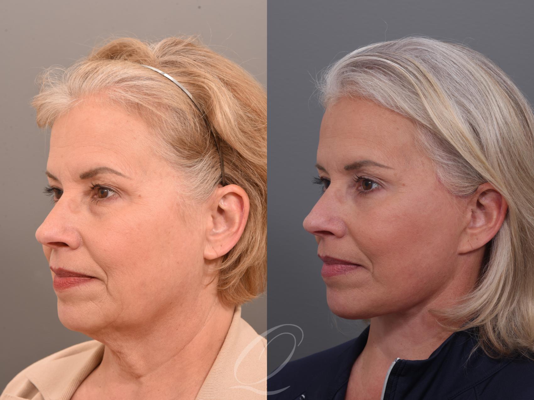 Brow Lift Case 1001897 Before & After Front | Serving Rochester, Syracuse & Buffalo, NY | Quatela Center for Plastic Surgery
