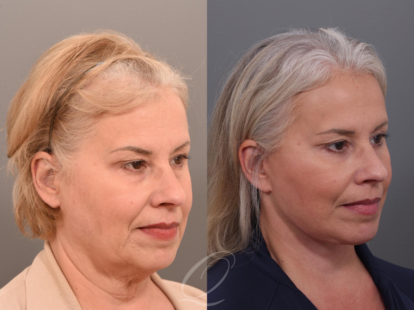 Brow Lift Case 1001897 Before & After Left Side | Serving Rochester, Syracuse & Buffalo, NY | Quatela Center for Plastic Surgery