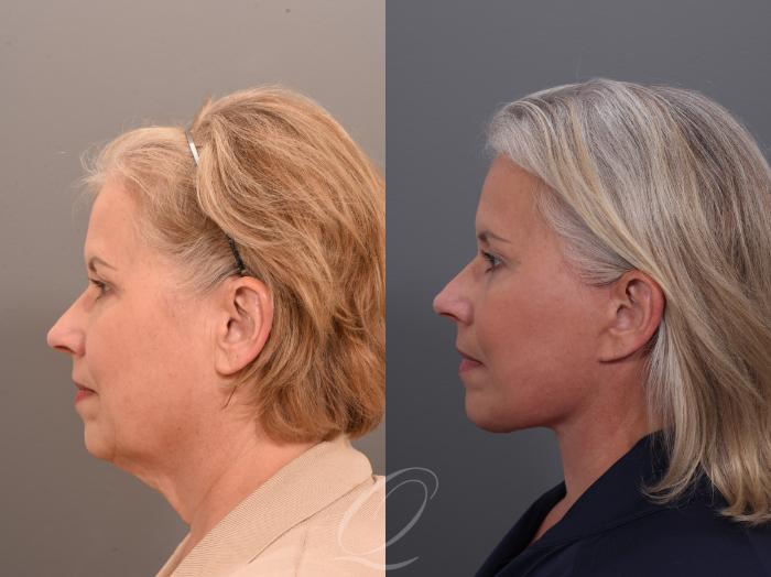 Brow Lift Case 1001897 Before & After Right Side | Serving Rochester, Syracuse & Buffalo, NY | Quatela Center for Plastic Surgery