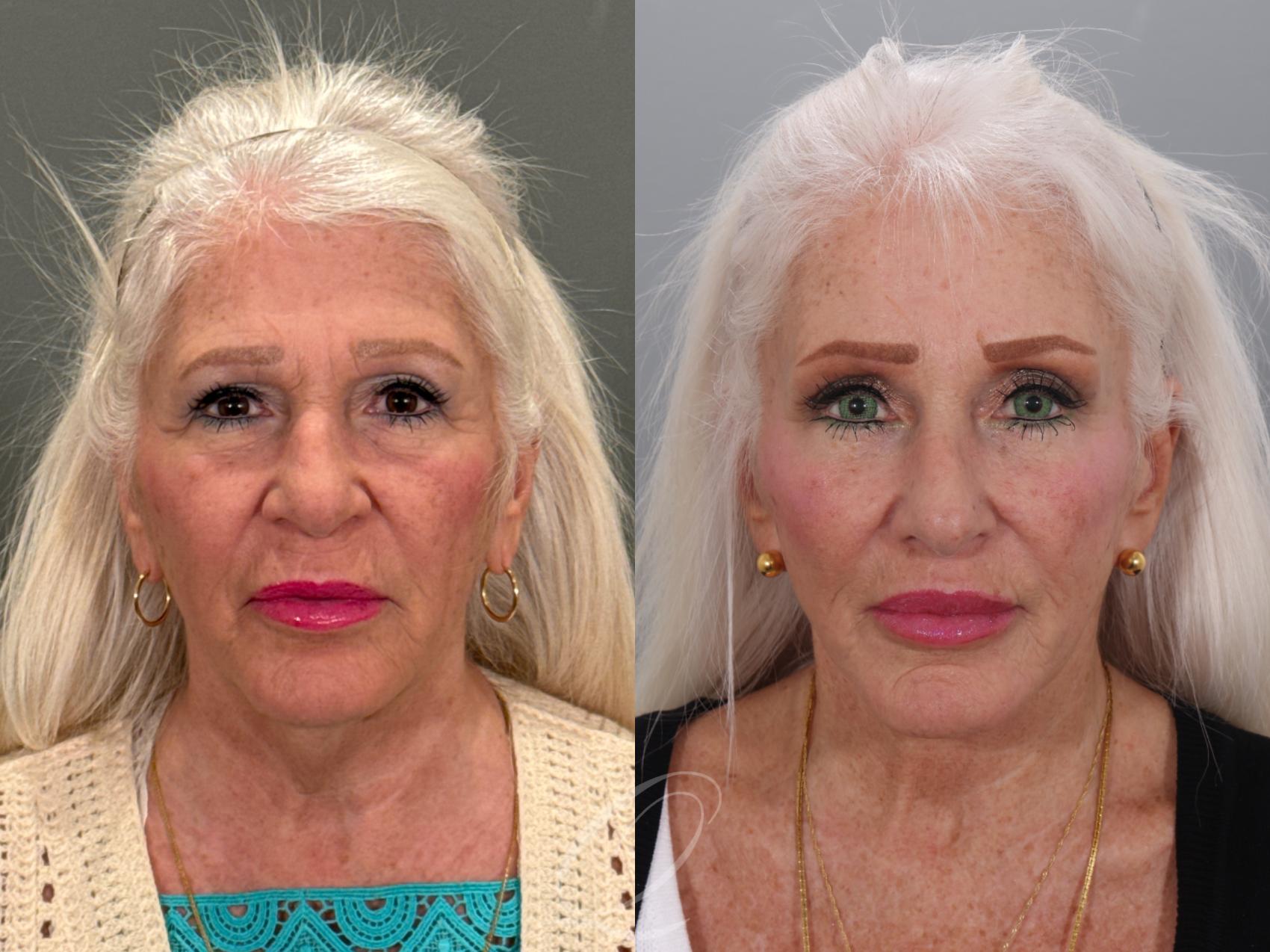 Facelift Case 1001926 Before & After Front | Serving Rochester, Syracuse & Buffalo, NY | Quatela Center for Plastic Surgery