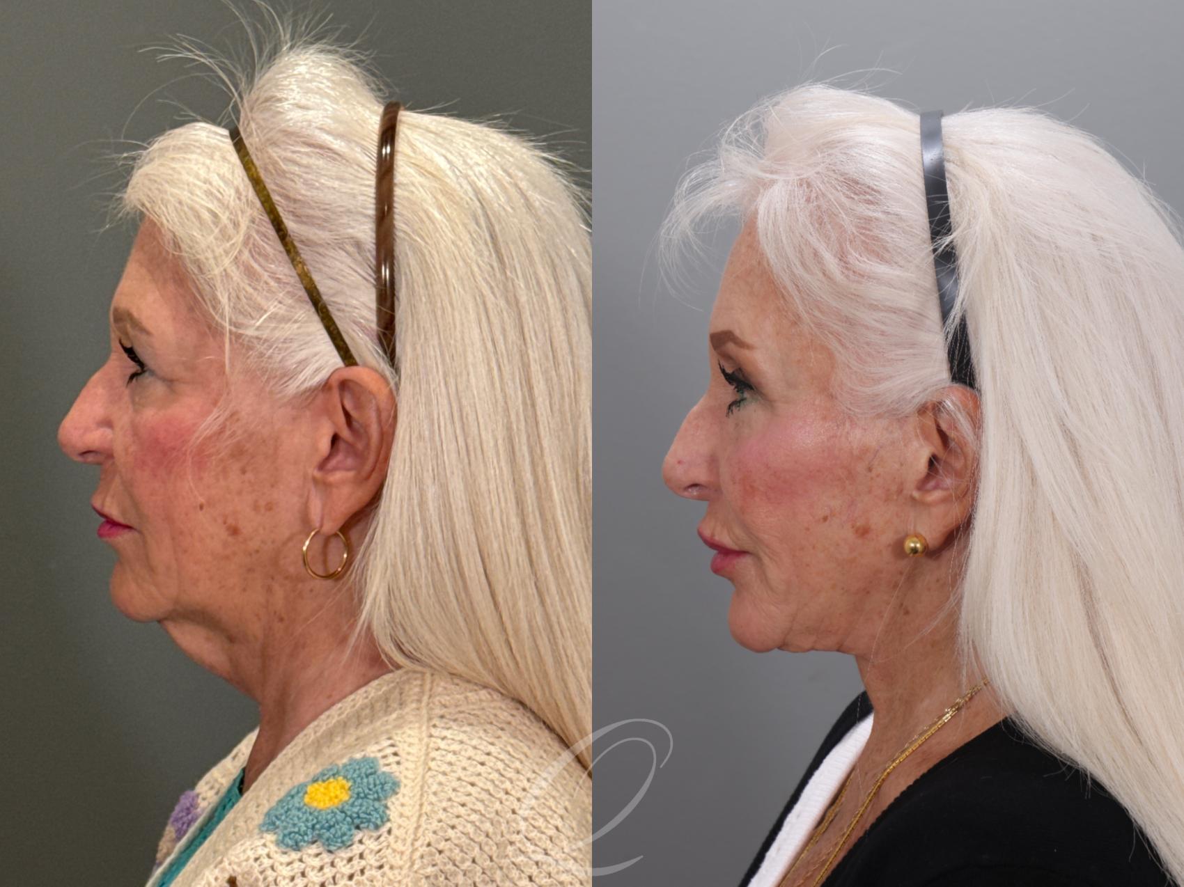 Facelift Case 1001926 Before & After Left Side | Serving Rochester, Syracuse & Buffalo, NY | Quatela Center for Plastic Surgery
