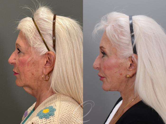 Facelift Case 1001926 Before & After Left Side | Serving Rochester, Syracuse & Buffalo, NY | Quatela Center for Plastic Surgery