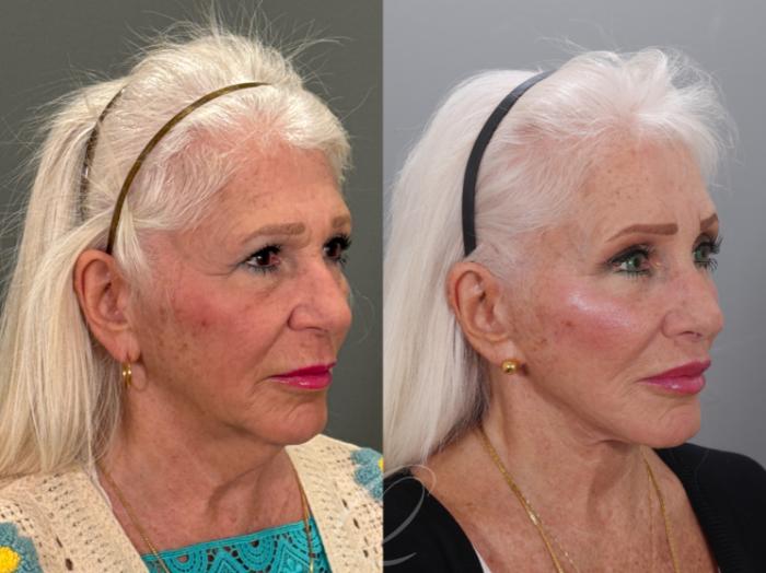 Facelift Case 1001926 Before & After Right Oblique | Serving Rochester, Syracuse & Buffalo, NY | Quatela Center for Plastic Surgery
