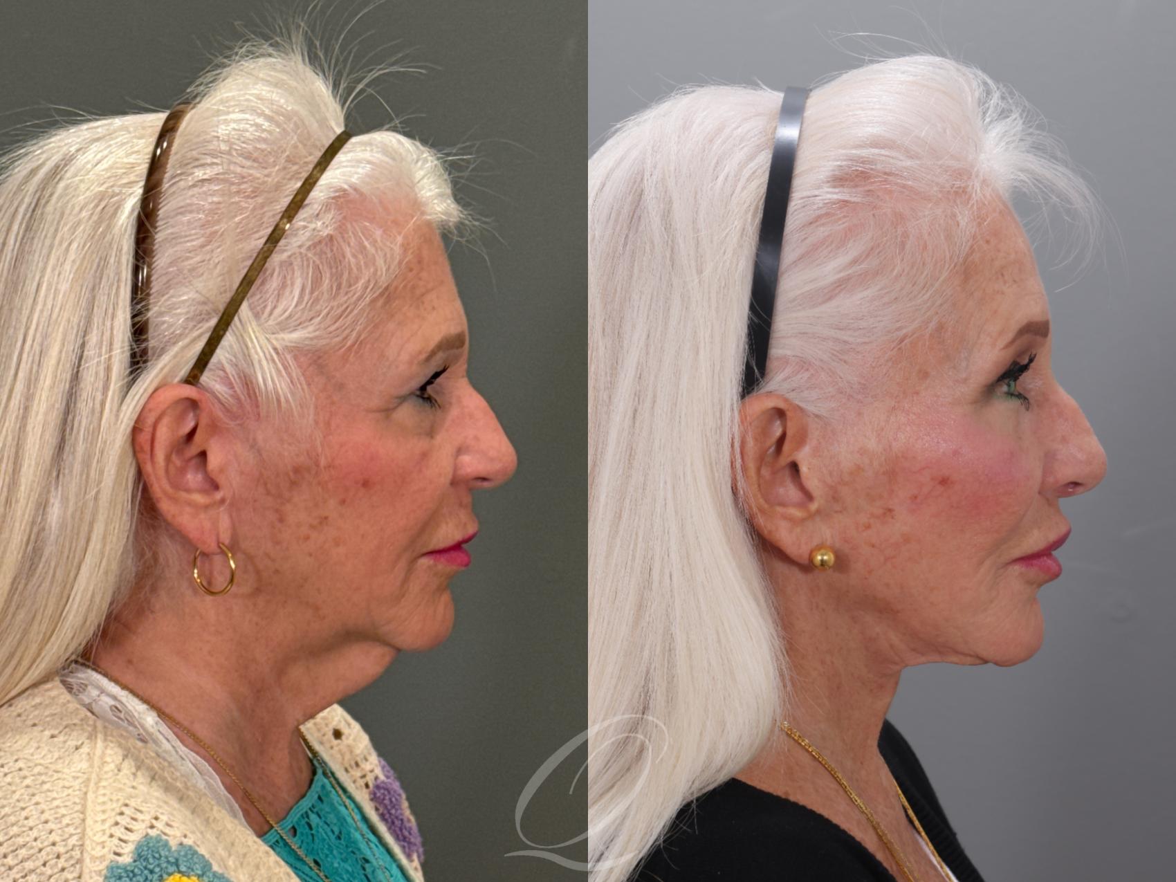 Facelift Case 1001926 Before & After Right Side | Serving Rochester, Syracuse & Buffalo, NY | Quatela Center for Plastic Surgery