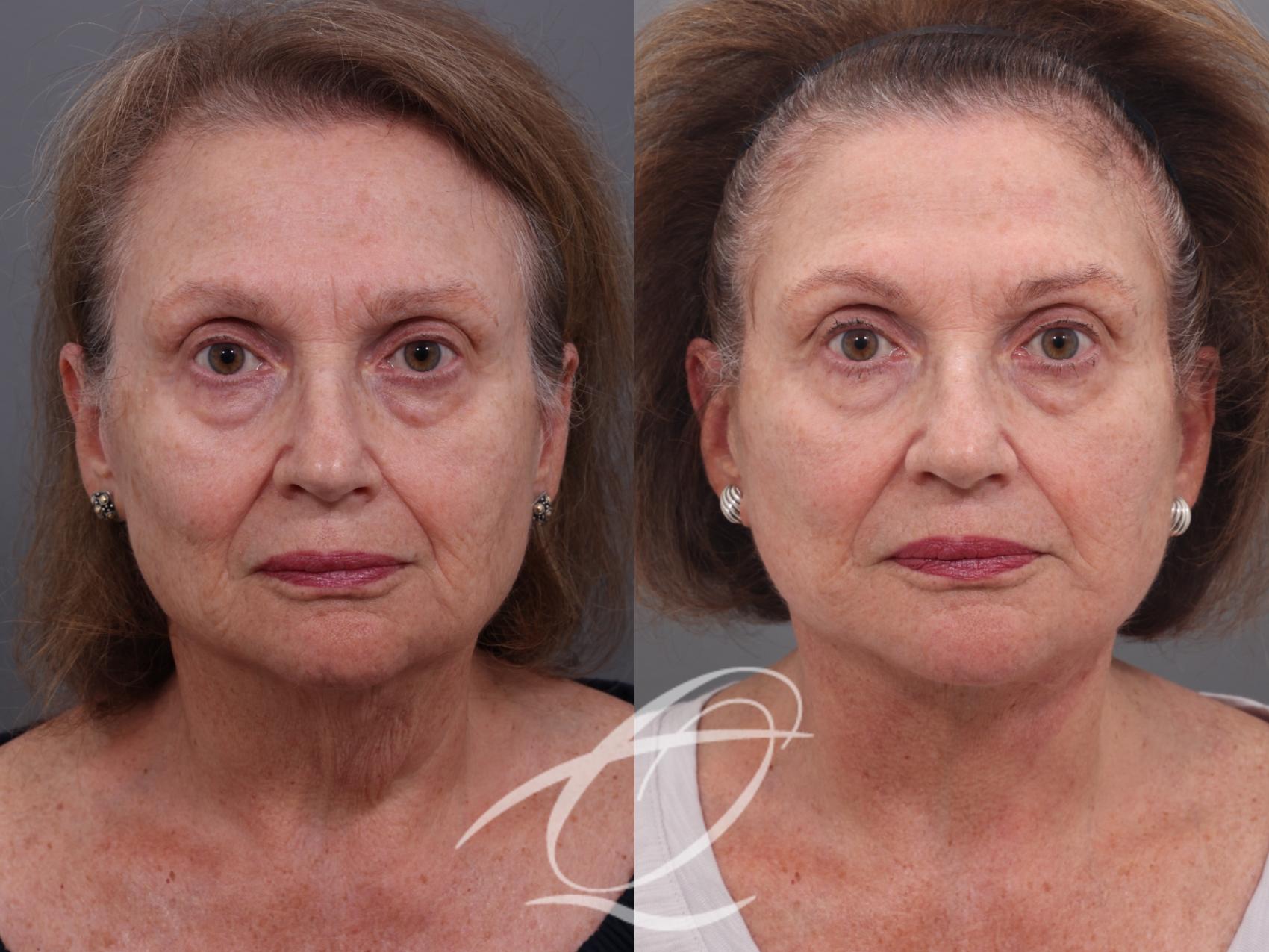 Facelift Case 1001940 Before & After Front | Serving Rochester, Syracuse & Buffalo, NY | Quatela Center for Plastic Surgery