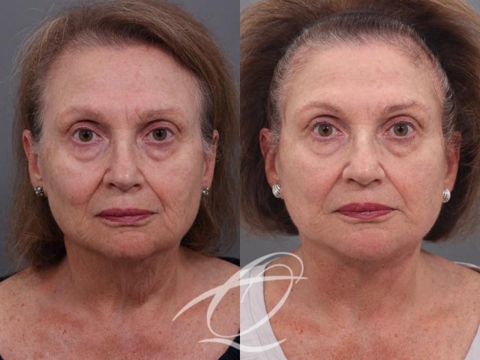 Facelift Case 1001940 Before & After Front | Serving Rochester, Syracuse & Buffalo, NY | Quatela Center for Plastic Surgery