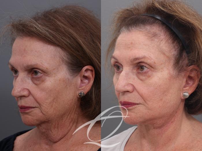 Facelift Case 1001940 Before & After Left Oblique | Serving Rochester, Syracuse & Buffalo, NY | Quatela Center for Plastic Surgery