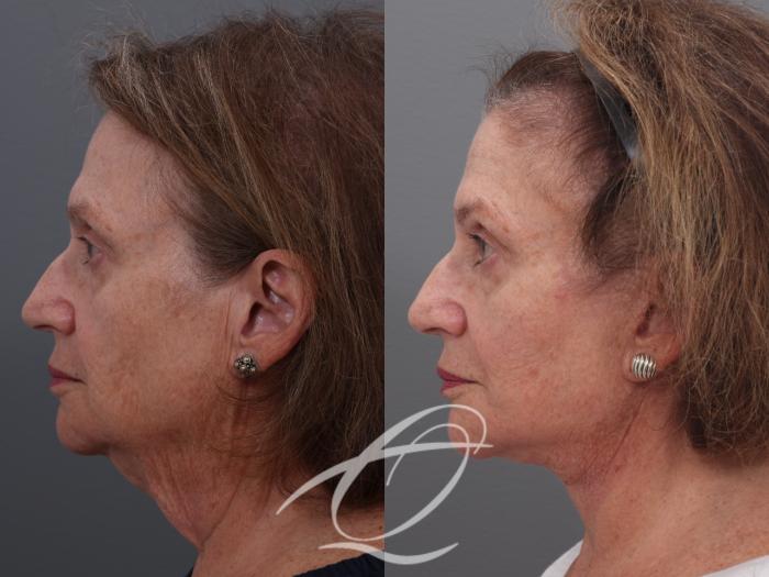 Facelift Case 1001940 Before & After Left Side | Serving Rochester, Syracuse & Buffalo, NY | Quatela Center for Plastic Surgery