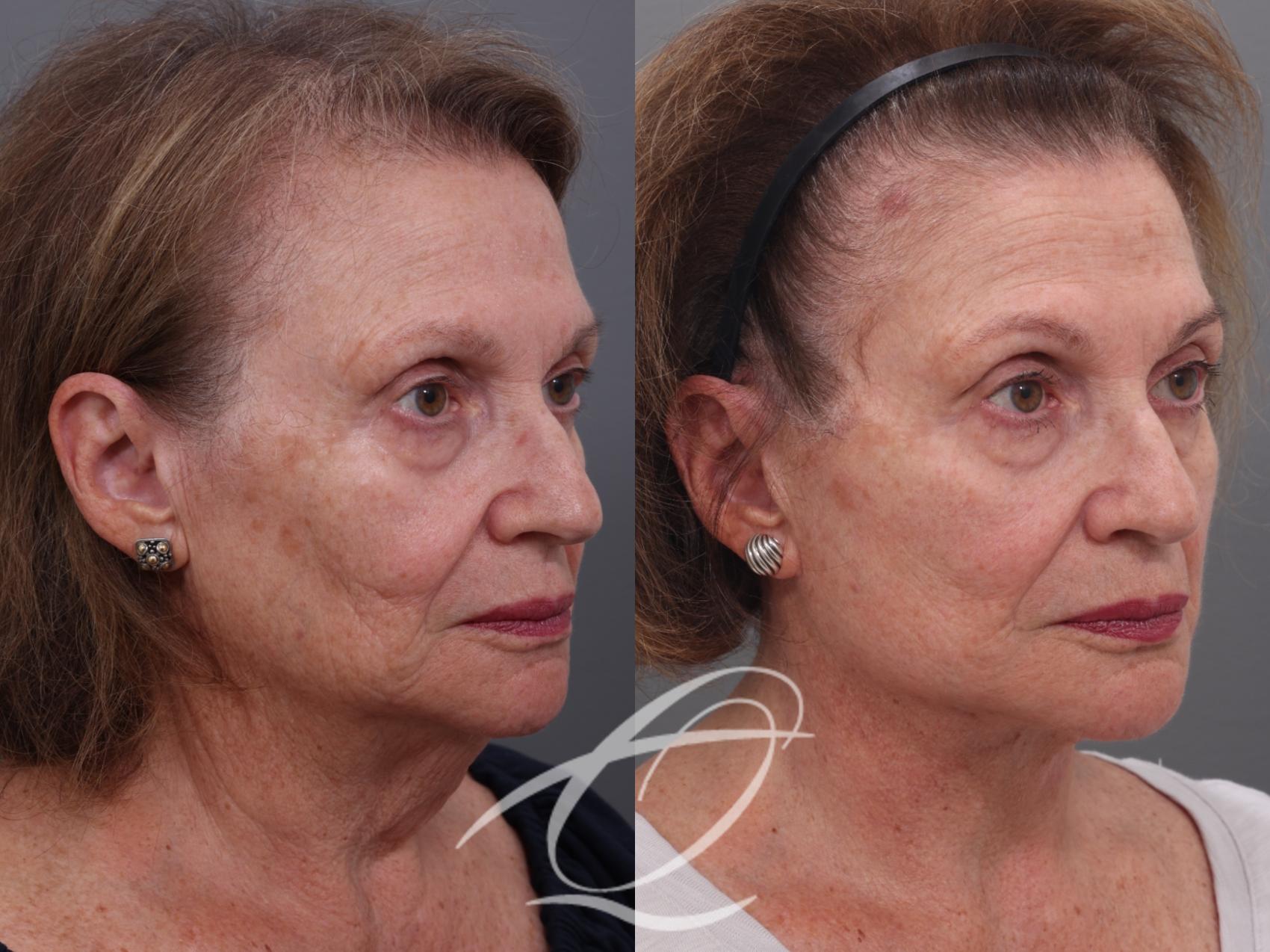 Facelift Case 1001940 Before & After Right Oblique | Serving Rochester, Syracuse & Buffalo, NY | Quatela Center for Plastic Surgery