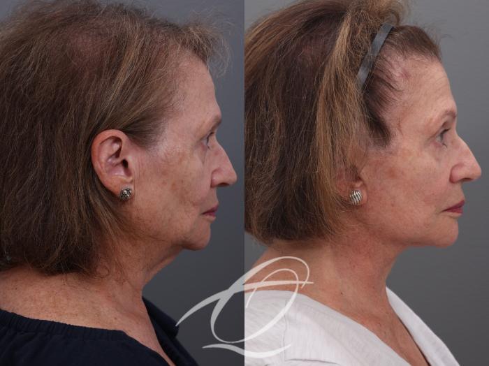 Facelift Case 1001940 Before & After Right Side | Serving Rochester, Syracuse & Buffalo, NY | Quatela Center for Plastic Surgery