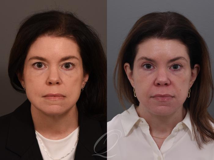 Facelift Case 1001944 Before & After Front | Serving Rochester, Syracuse & Buffalo, NY | Quatela Center for Plastic Surgery