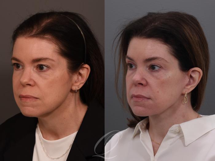 Facelift Case 1001944 Before & After Left Oblique | Serving Rochester, Syracuse & Buffalo, NY | Quatela Center for Plastic Surgery