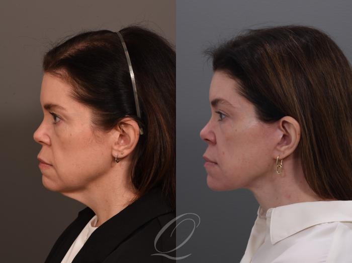 Facelift Case 1001944 Before & After Left Side | Serving Rochester, Syracuse & Buffalo, NY | Quatela Center for Plastic Surgery