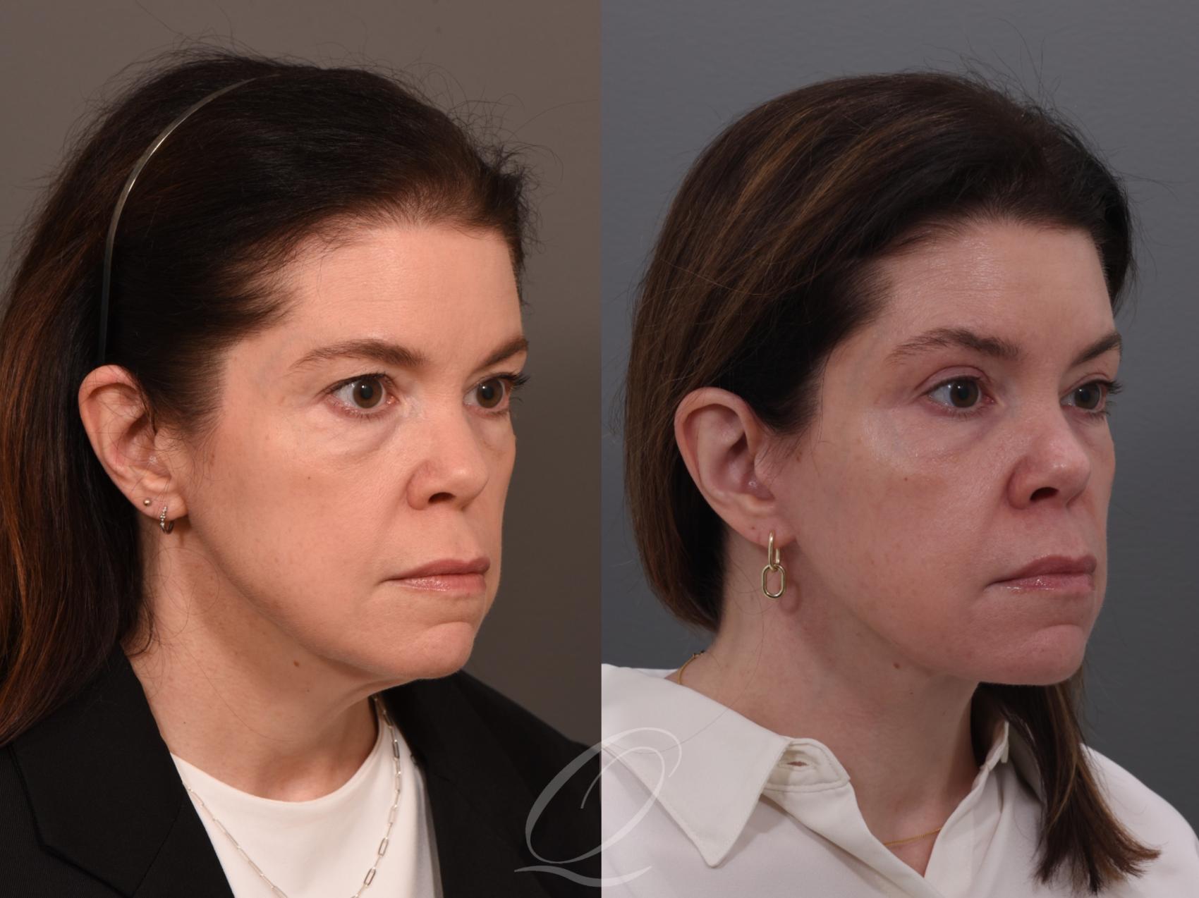Facelift Case 1001944 Before & After Right Oblique | Serving Rochester, Syracuse & Buffalo, NY | Quatela Center for Plastic Surgery