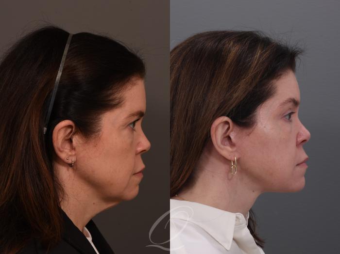 Facelift Case 1001944 Before & After Right Side | Serving Rochester, Syracuse & Buffalo, NY | Quatela Center for Plastic Surgery