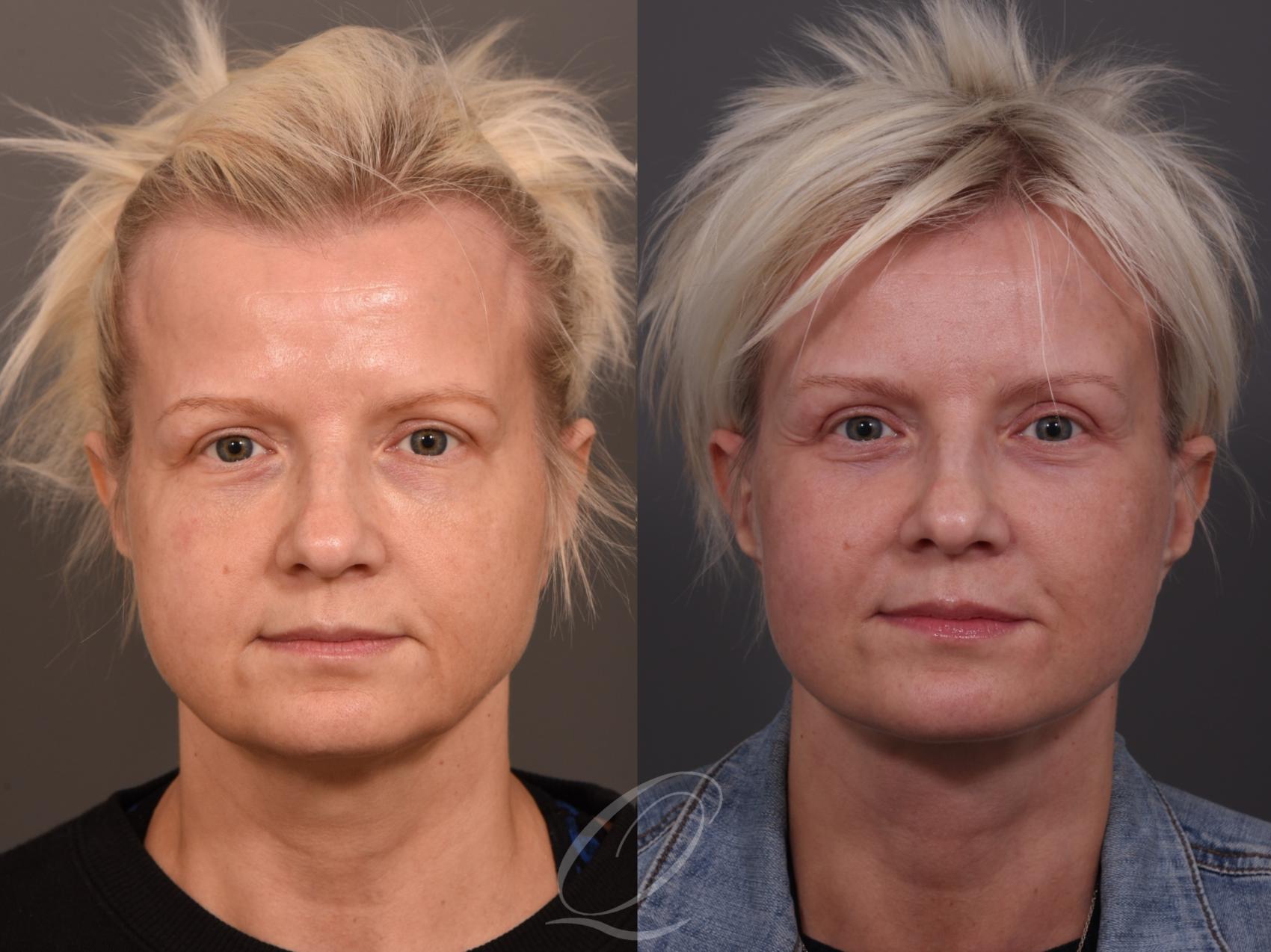 Facelift Case 1001957 Before & After Front | Serving Rochester, Syracuse & Buffalo, NY | Quatela Center for Plastic Surgery