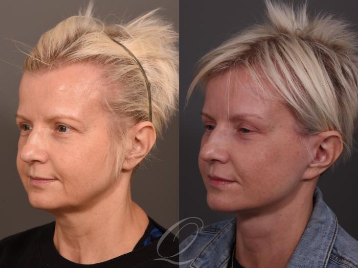 Facelift Case 1001957 Before & After Left Oblique | Serving Rochester, Syracuse & Buffalo, NY | Quatela Center for Plastic Surgery