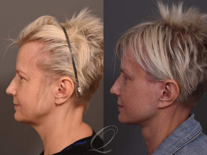 Facelift Case 1001957 Before & After Left Side | Serving Rochester, Syracuse & Buffalo, NY | Quatela Center for Plastic Surgery