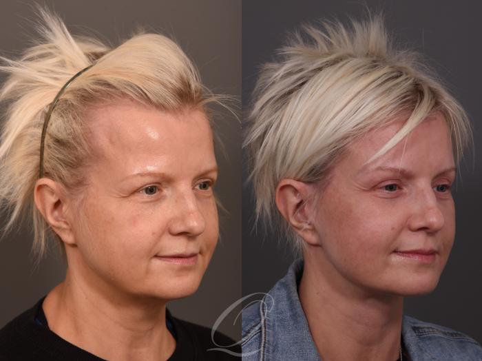 Facelift Case 1001957 Before & After Right Oblique | Serving Rochester, Syracuse & Buffalo, NY | Quatela Center for Plastic Surgery