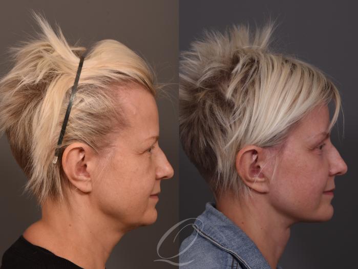 Facelift Case 1001957 Before & After Right Side | Serving Rochester, Syracuse & Buffalo, NY | Quatela Center for Plastic Surgery