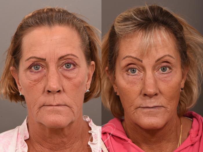 Facelift Case 1001964 Before & After Front | Serving Rochester, Syracuse & Buffalo, NY | Quatela Center for Plastic Surgery
