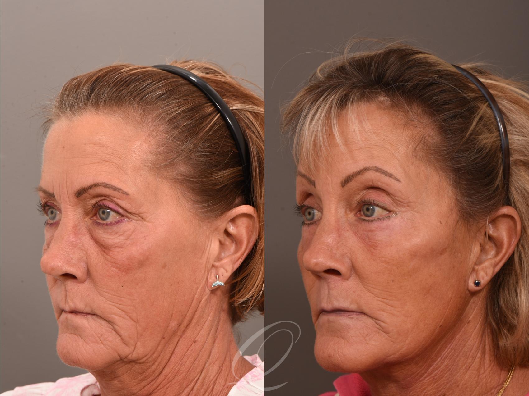 Facelift Case 1001964 Before & After Left Oblique | Serving Rochester, Syracuse & Buffalo, NY | Quatela Center for Plastic Surgery