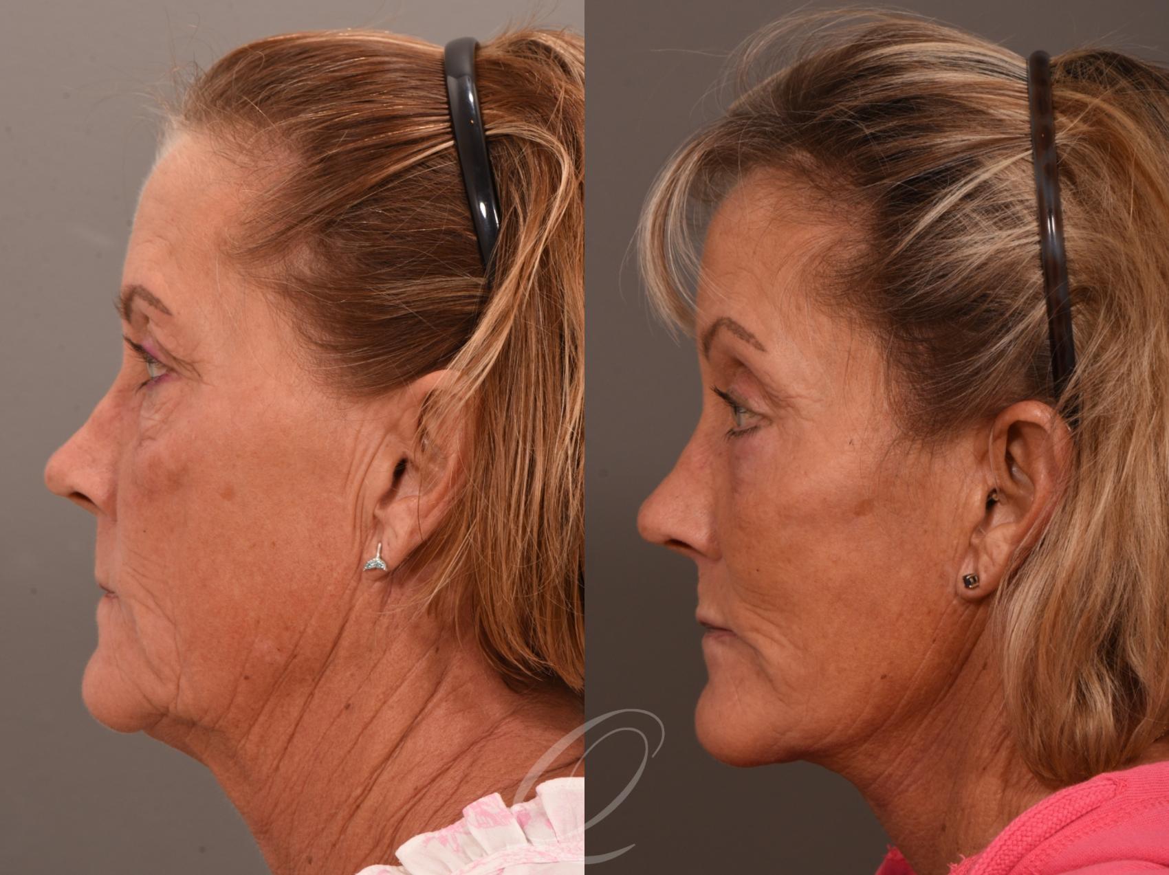 Facelift Case 1001964 Before & After Left Side | Serving Rochester, Syracuse & Buffalo, NY | Quatela Center for Plastic Surgery