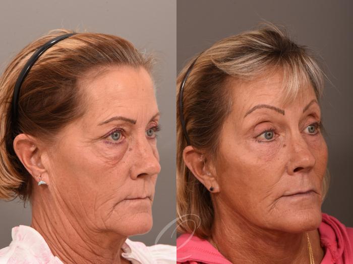 Facelift Case 1001964 Before & After Right Oblique | Serving Rochester, Syracuse & Buffalo, NY | Quatela Center for Plastic Surgery
