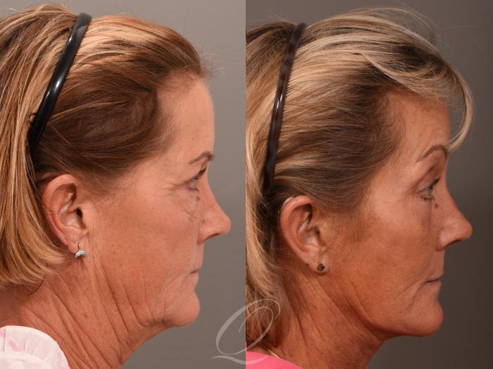 Facelift Case 1001964 Before & After Right Side | Serving Rochester, Syracuse & Buffalo, NY | Quatela Center for Plastic Surgery