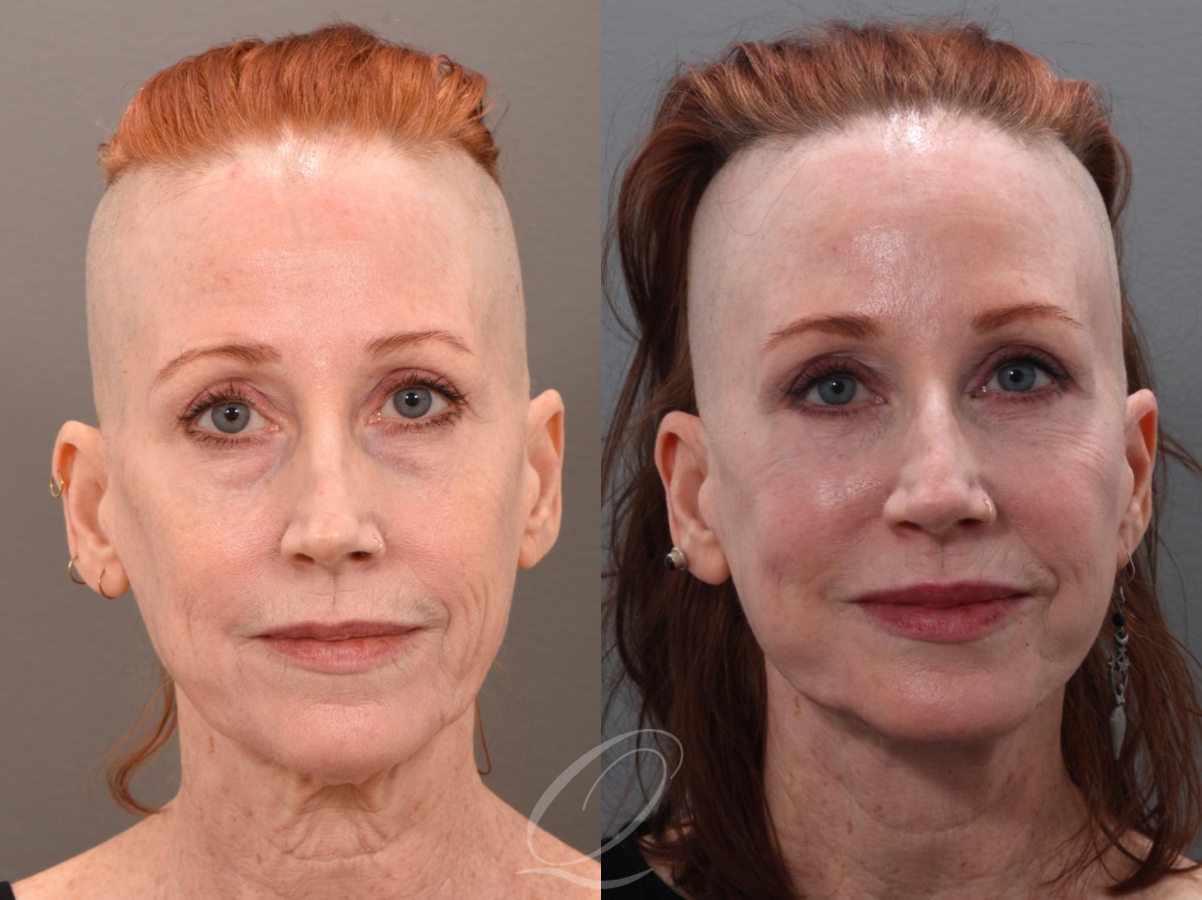 Facelift Case 1001972 Before & After Front | Serving Rochester, Syracuse & Buffalo, NY | Quatela Center for Plastic Surgery