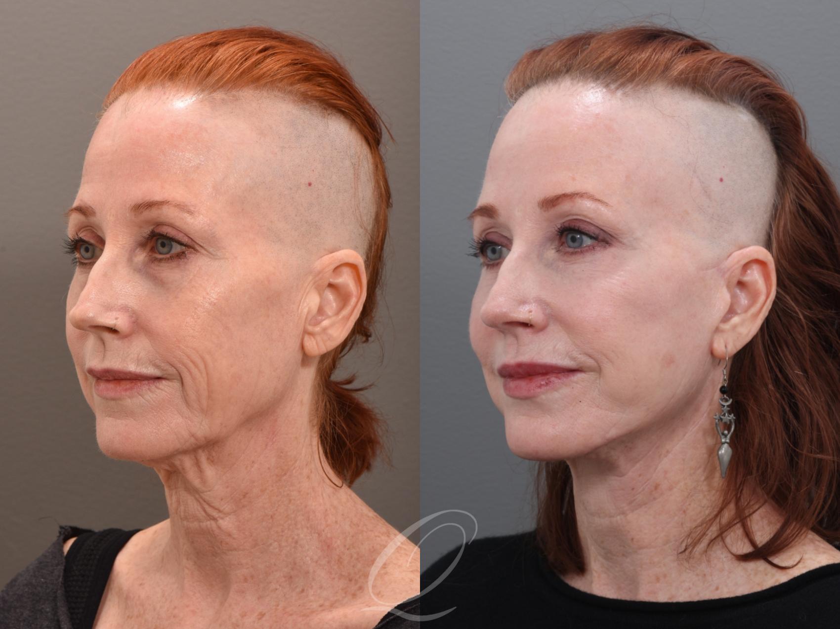 Facelift Case 1001972 Before & After Left Oblique | Serving Rochester, Syracuse & Buffalo, NY | Quatela Center for Plastic Surgery