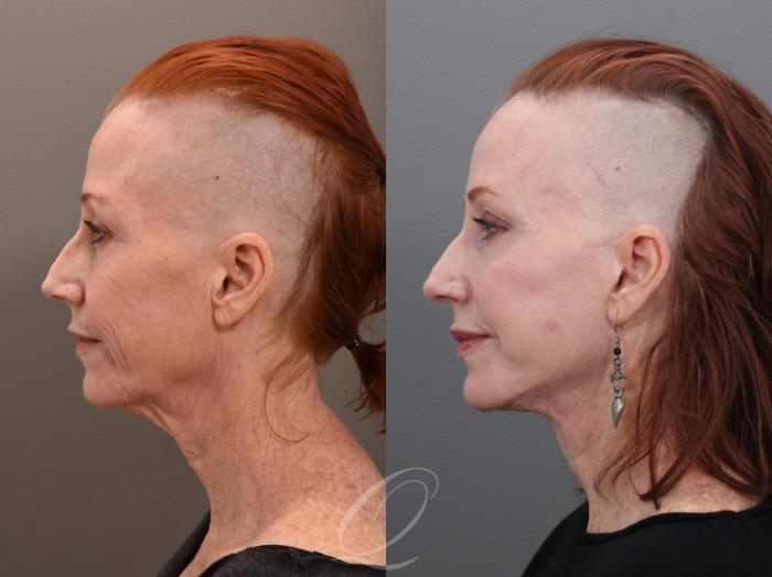 Facelift Case 1001972 Before & After Left Side | Serving Rochester, Syracuse & Buffalo, NY | Quatela Center for Plastic Surgery