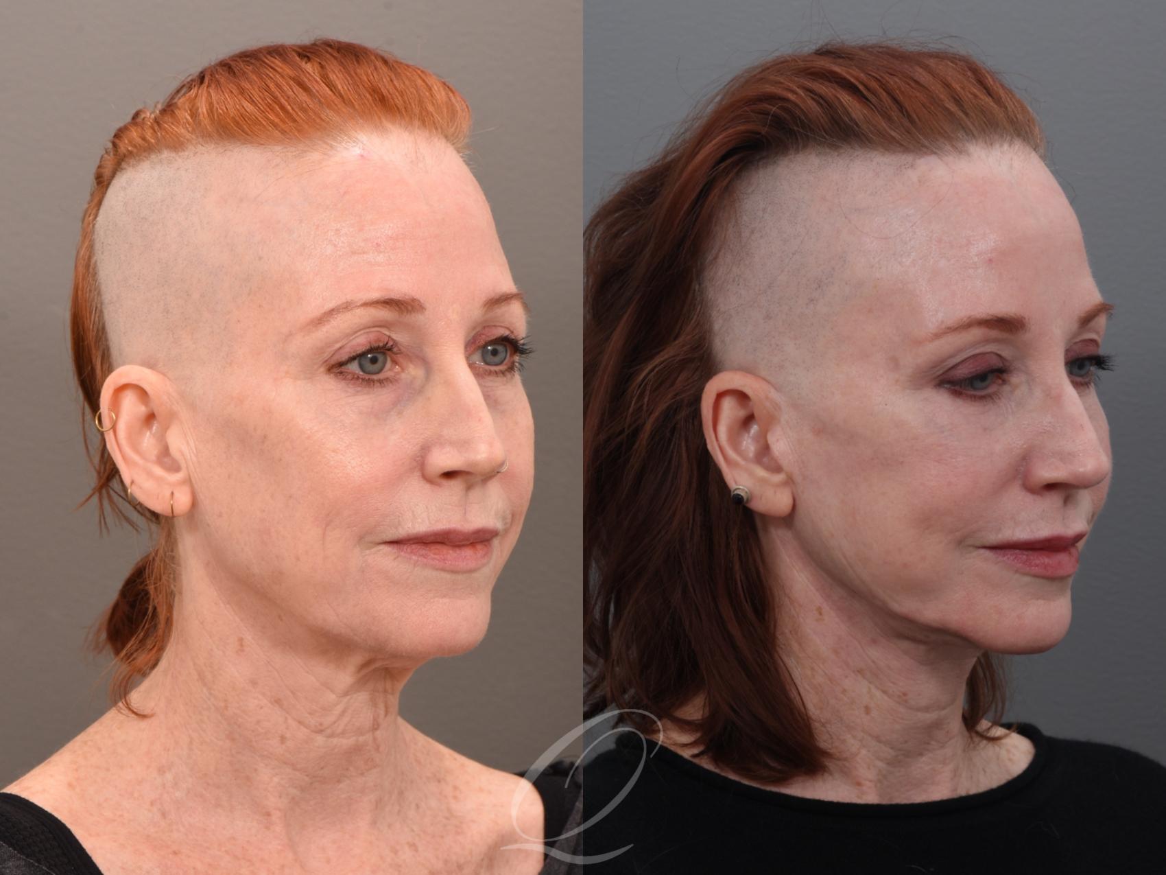 Facelift Case 1001972 Before & After Right Oblique | Serving Rochester, Syracuse & Buffalo, NY | Quatela Center for Plastic Surgery