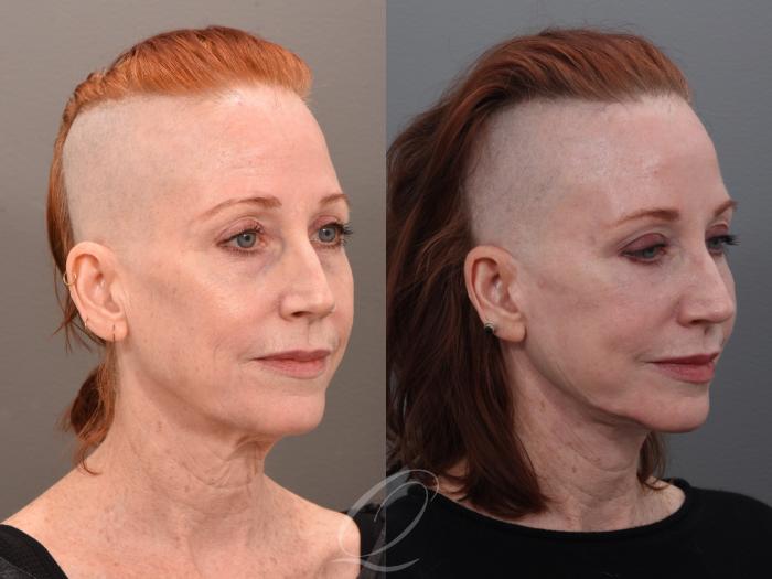 Facelift Case 1001972 Before & After Right Oblique | Serving Rochester, Syracuse & Buffalo, NY | Quatela Center for Plastic Surgery