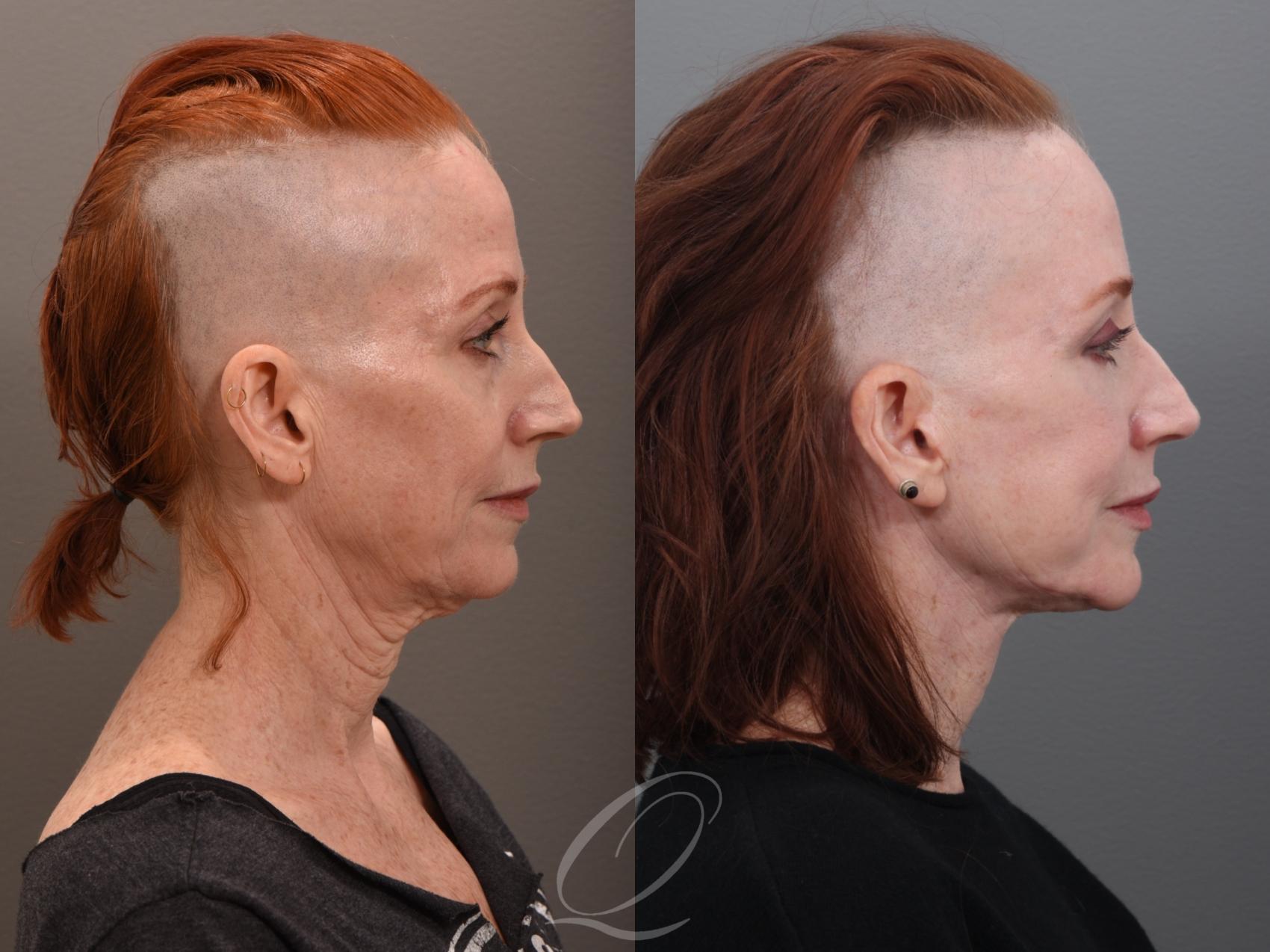 Facelift Case 1001972 Before & After Right Side | Serving Rochester, Syracuse & Buffalo, NY | Quatela Center for Plastic Surgery