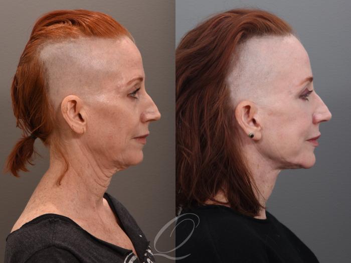 Facelift Case 1001972 Before & After Right Side | Serving Rochester, Syracuse & Buffalo, NY | Quatela Center for Plastic Surgery