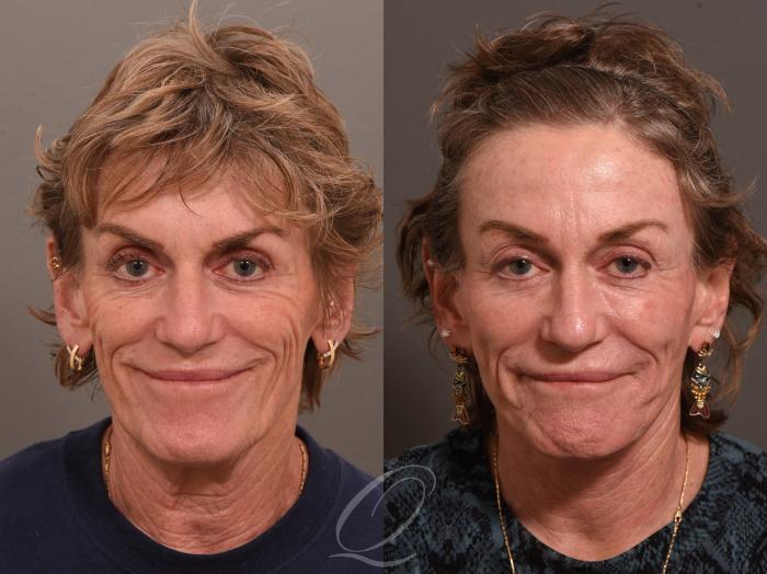 Facelift Case 1001983 Before & After Front | Serving Rochester, Syracuse & Buffalo, NY | Quatela Center for Plastic Surgery