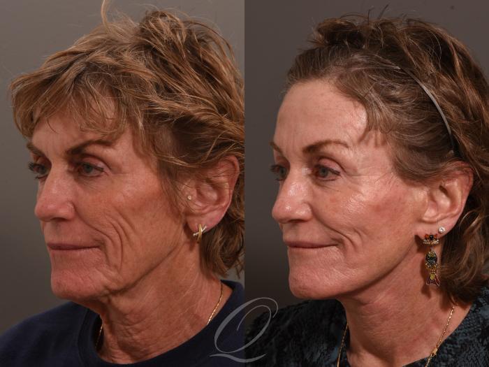 Facelift Case 1001983 Before & After Left Oblique | Serving Rochester, Syracuse & Buffalo, NY | Quatela Center for Plastic Surgery