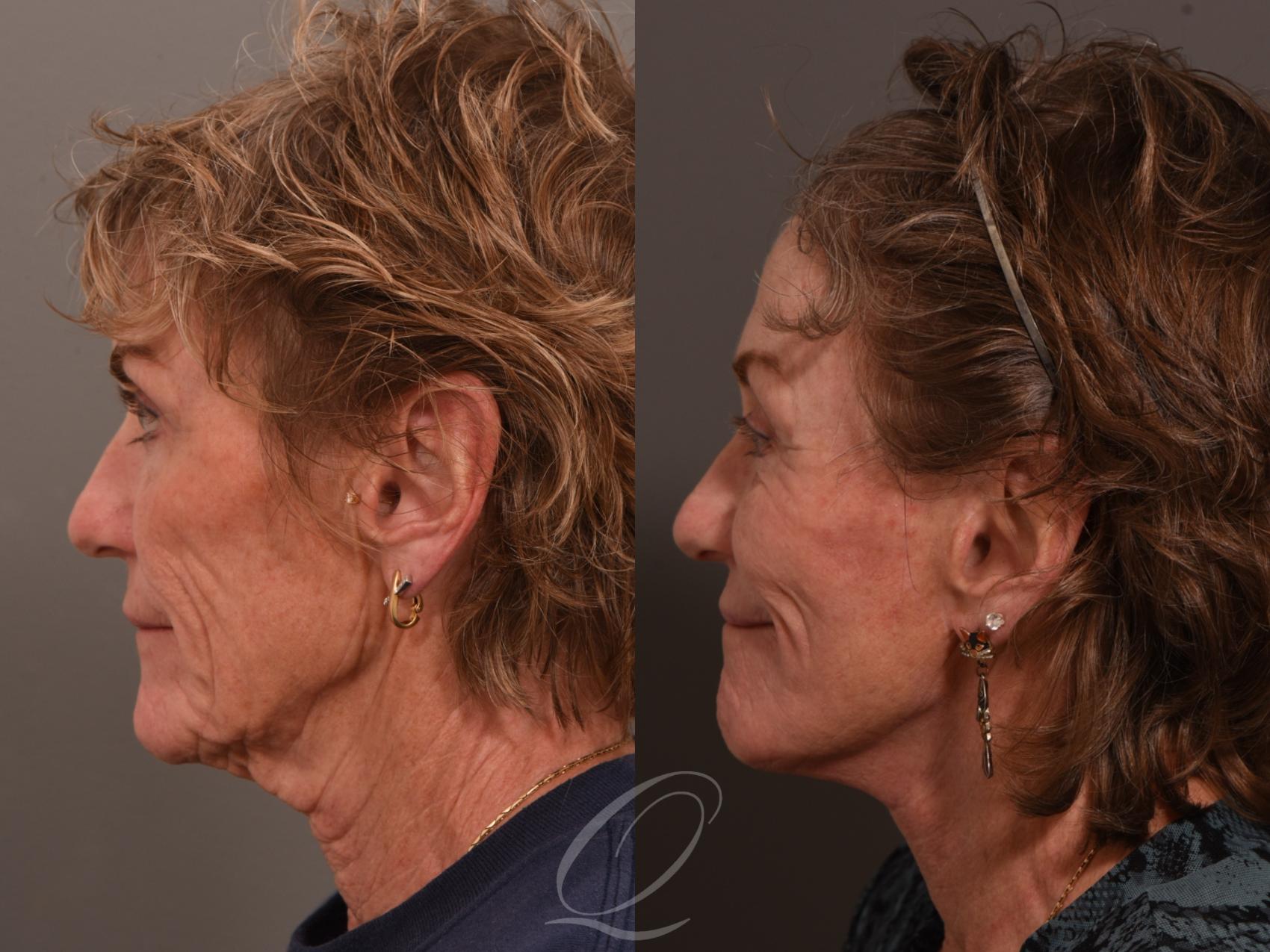 Facelift Case 1001983 Before & After Left Side | Serving Rochester, Syracuse & Buffalo, NY | Quatela Center for Plastic Surgery
