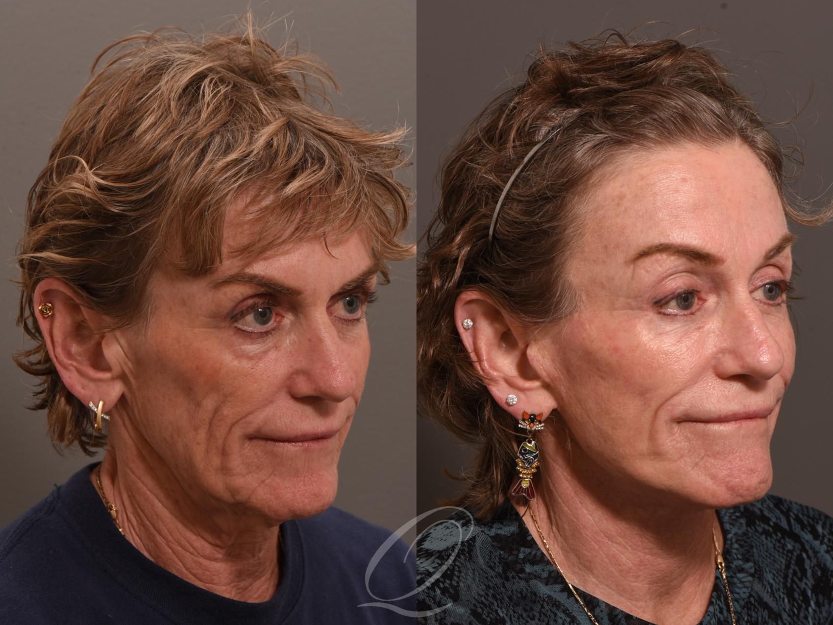 Facelift Case 1001983 Before & After Right Oblique | Serving Rochester, Syracuse & Buffalo, NY | Quatela Center for Plastic Surgery