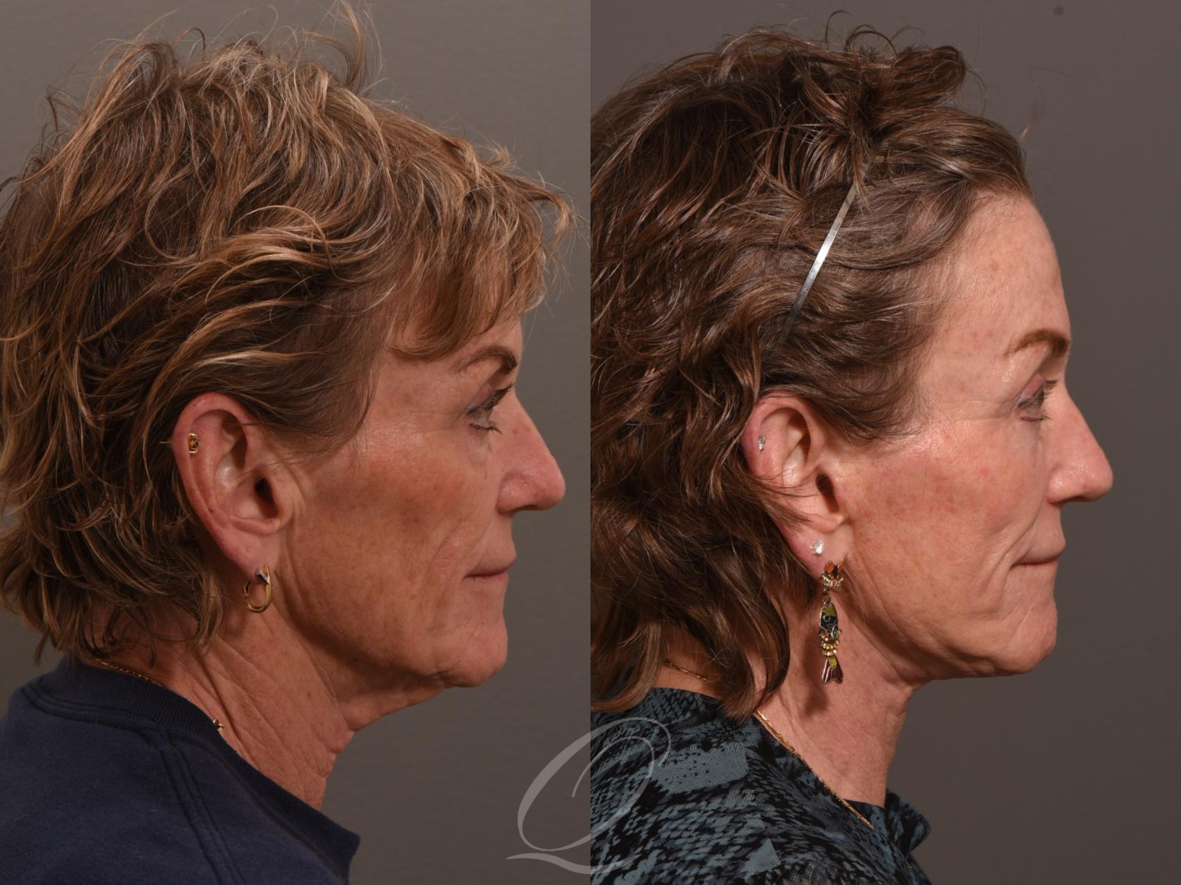 Facelift Case 1001983 Before & After Right Side | Serving Rochester, Syracuse & Buffalo, NY | Quatela Center for Plastic Surgery